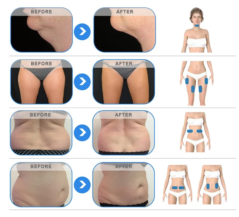 7-Handle 4D Cryolipolysis Machine With Exclusive Design Patent suppliers