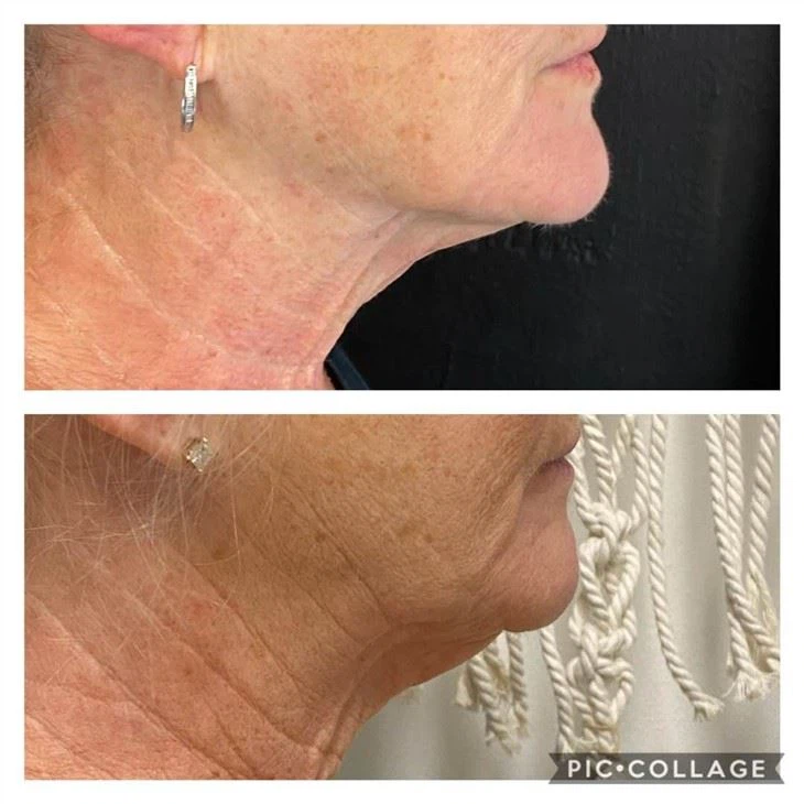 Portable Cryoskin 4.0