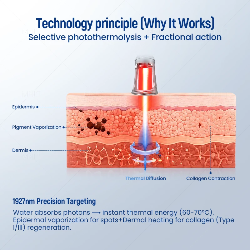 1927nm Thulium Laser Skin Rejuvenation System – Advanced Non-Ablative Laser Solution For Modern Aesthetic Clinics factory