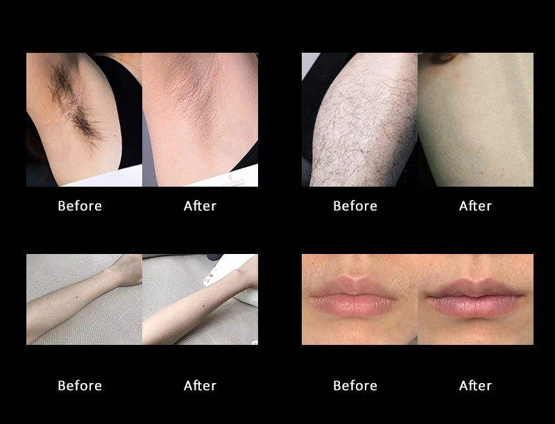 2026 Diode Laser Hair Removal Machine price