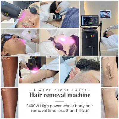 Máquina de depilación láser de diodo para cuerpo y rostro