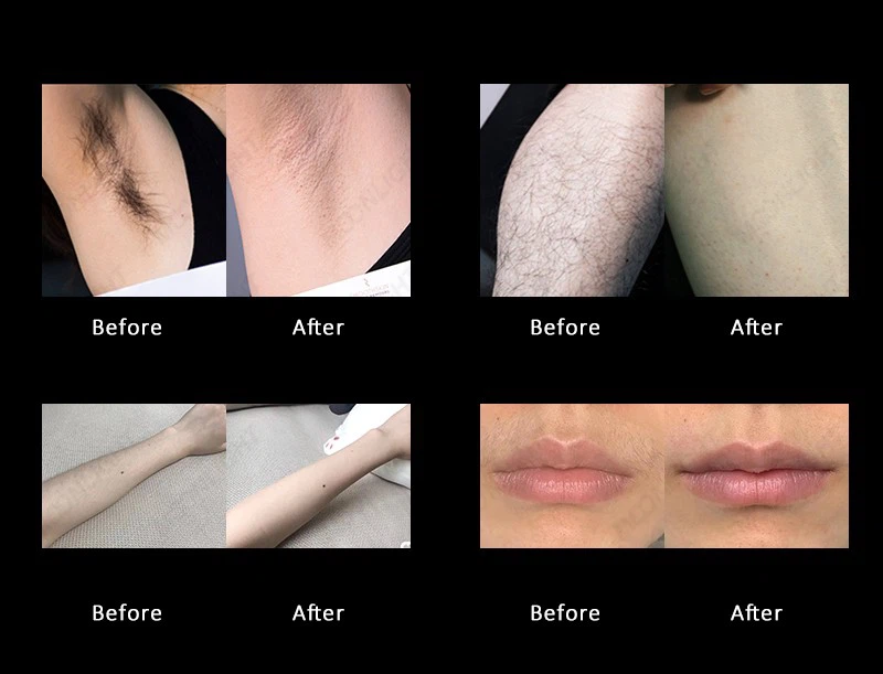 Soprano Titanium Diode Laser Hair Removal Machine – Christmas $200 OFF Factory Deal price